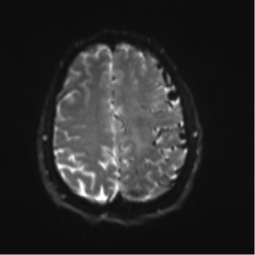 File:Cerebral arteriovenous malformation - huge (Radiopaedia 35734-37272 Axial DWI 18).png