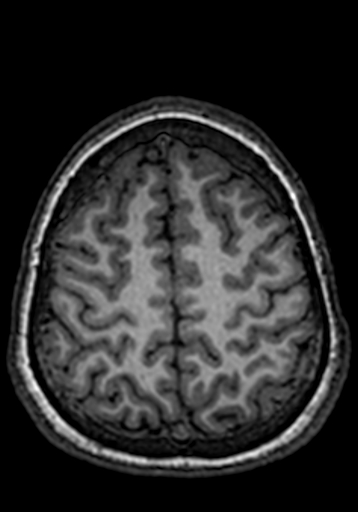 File:Cerebral arteriovenous malformation at posterior body of corpus callosum (Radiopaedia 74111-84925 Axial T1 50).jpg