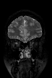 Cerebral arteriovenous malformation at posterior body of corpus callosum (Radiopaedia 74111-84925 Coronal T2 31).jpg