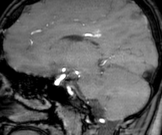 Cerebral arteriovenous malformation at posterior body of corpus callosum (Radiopaedia 74111-84925 J 167).jpg