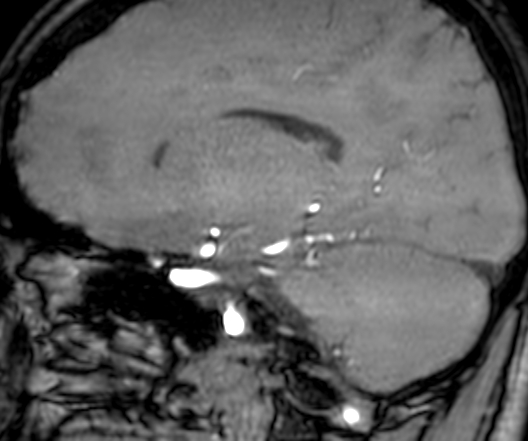 Cerebral arteriovenous malformation at posterior body of corpus callosum (Radiopaedia 74111-84925 J 240).jpg