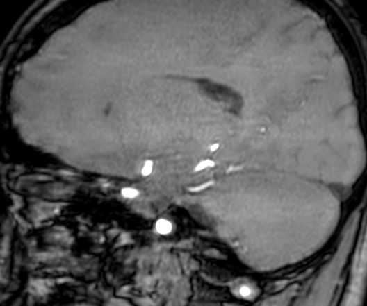 Cerebral arteriovenous malformation at posterior body of corpus callosum (Radiopaedia 74111-84925 J 246).jpg