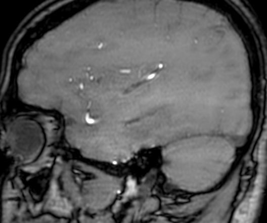 Cerebral arteriovenous malformation at posterior body of corpus callosum (Radiopaedia 74111-84925 J 302).jpg