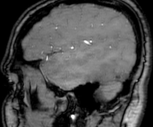 Cerebral arteriovenous malformation at posterior body of corpus callosum (Radiopaedia 74111-84925 J 342).jpg
