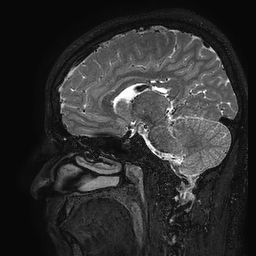 Cerebral arteriovenous malformation at posterior body of corpus callosum (Radiopaedia 74111-84925 Sagittal T2 75).jpg