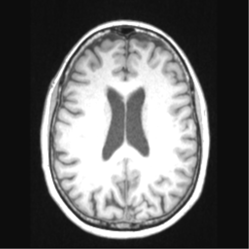 Cerebral arteriovenous malformation with hemorrhage (Radiopaedia 34422-35737 Axial T1 48).png