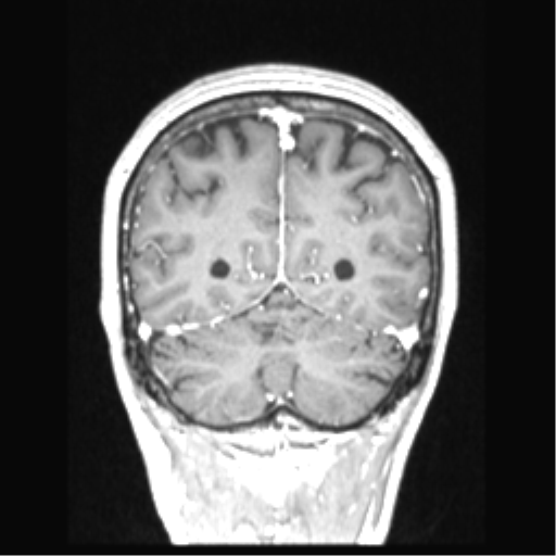 Cerebral arteriovenous malformation with hemorrhage (Radiopaedia 34422-35737 Coronal T1 C+ 24).png