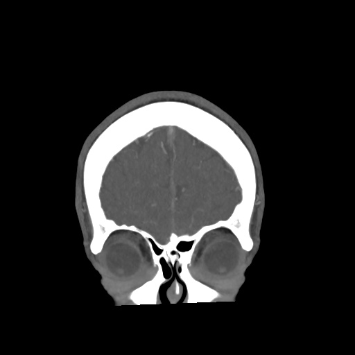 Cerebral arteriovenous malformation with lobar hemorrhage (Radiopaedia 35598-57216 C 13).jpg