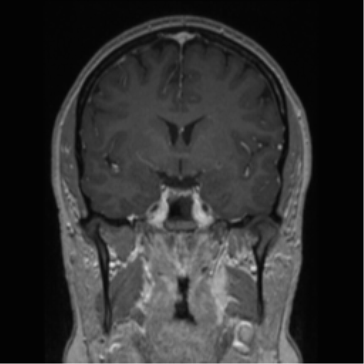 Cerebral cavernoma and development venous anomaly (Radiopaedia 37603-39482 Coronal T1 C+ 56).png