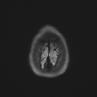 Cerebral cavernous venous malformation (Radiopaedia 70008-80021 Axial DWI 60).jpg