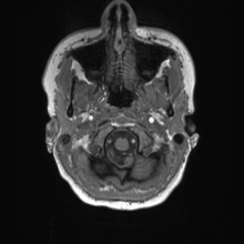File:Cerebral cavernous venous malformation (Radiopaedia 70008-80021 Axial T1 3).jpg
