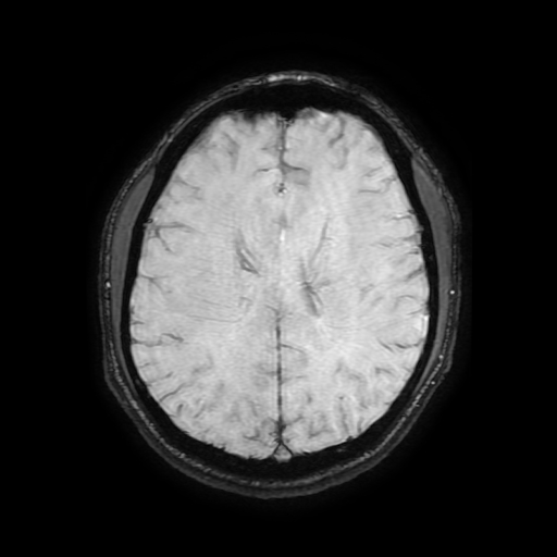 Cerebral cavernous venous malformation (Zabramski type II) (Radiopaedia 85511-101198 Axial SWI 79).jpg