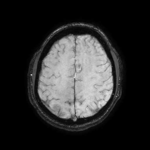 File:Cerebral cavernous venous malformation (Zabramski type II) (Radiopaedia 85511-101198 Axial SWI 90).jpg
