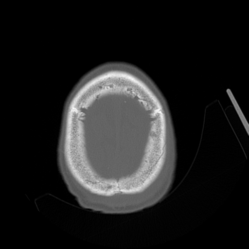 Cerebral contusions, subarachnoid hemorrhage and subdural hygromas (Radiopaedia 55399-61827 Axial bone window 47).png