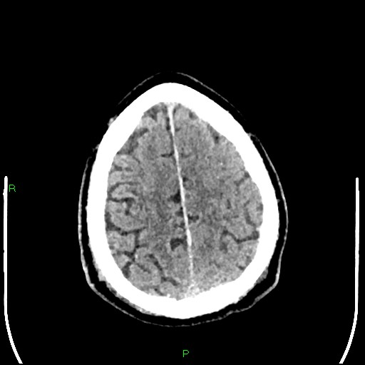 Cerebral contusions (Radiopaedia 33868-35039 Axial non-contrast 180).jpg