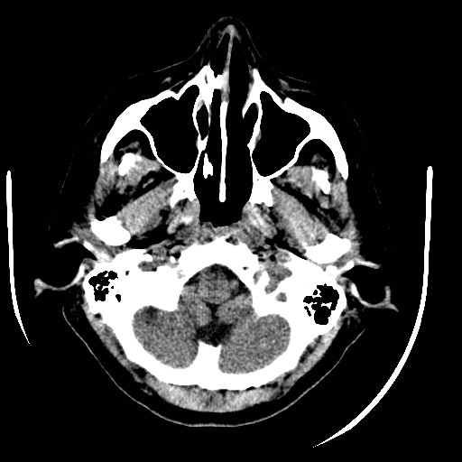 File:Cerebral edema (evolution in time) (Radiopaedia 19418-19440 non-contrast 14).jpg