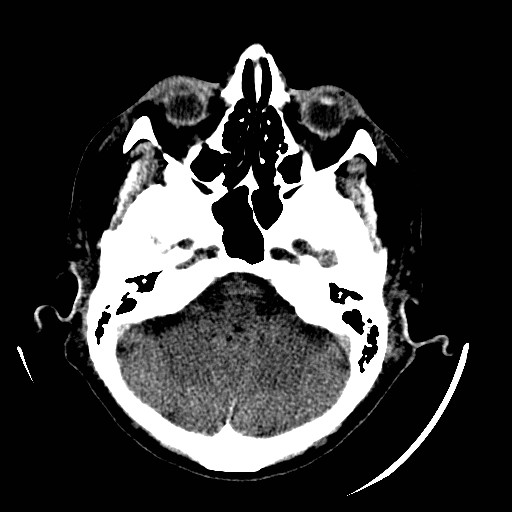 Cerebral edema (evolution in time) (Radiopaedia 19418-19440 non-contrast 26).jpg