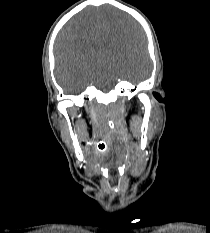 Cerebral edema in an overdose patient (Radiopaedia 72005-82539 B 45).jpg
