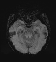 Cerebral embolic infarcts (embolic shower) (Radiopaedia 72391-82921 Axial SWI 27).jpg