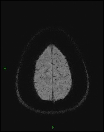 Cerebral fat embolism (Radiopaedia 35022-36525 Axial SWI 59).jpg