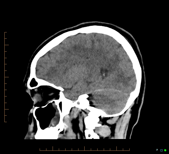 Cerebral fat embolism (Radiopaedia 85521-101220 B 36).jpg