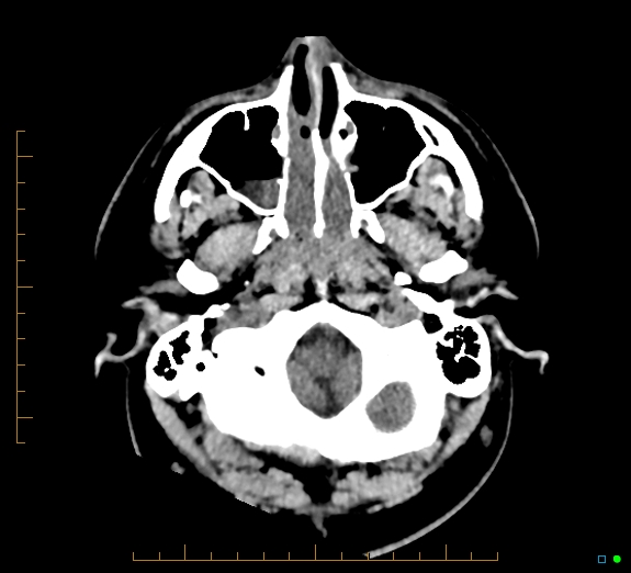 File:Cerebral fat embolism (Radiopaedia 85521-101224 Axial non-contrast 6).jpg