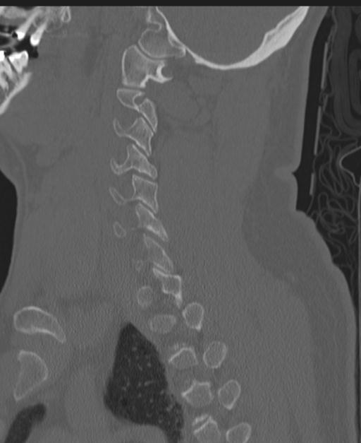 Cerebral hemorrhagic contusions and cervical spine fractures (Radiopaedia 32865-33841 Sagittal bone window 66).jpg