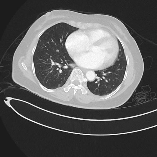 Cerebral metastases (Radiopaedia 33041-34055 Axial lung window 35).png