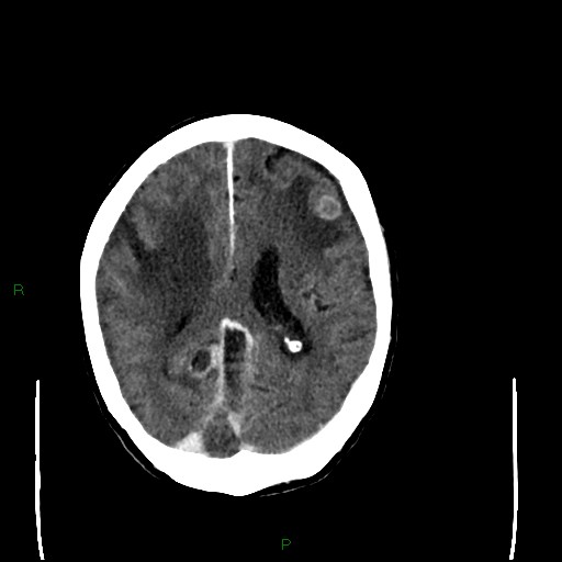 File:Cerebral metastases - breast primary (Radiopaedia 77653-89857 Axial C+ delayed 73).jpg