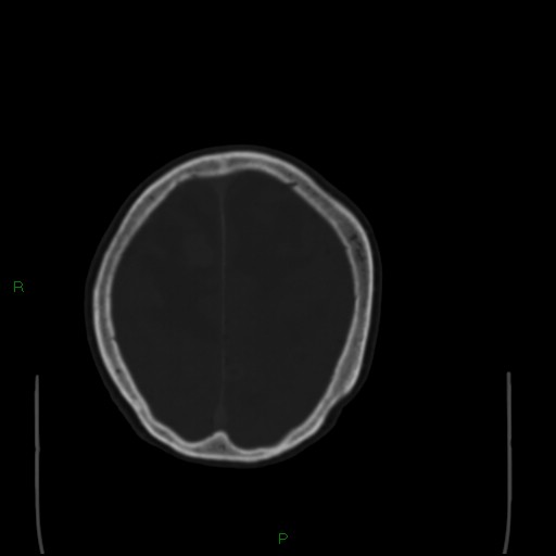 File:Cerebral metastases - breast primary (Radiopaedia 77653-89857 Axial bone window 93).jpg