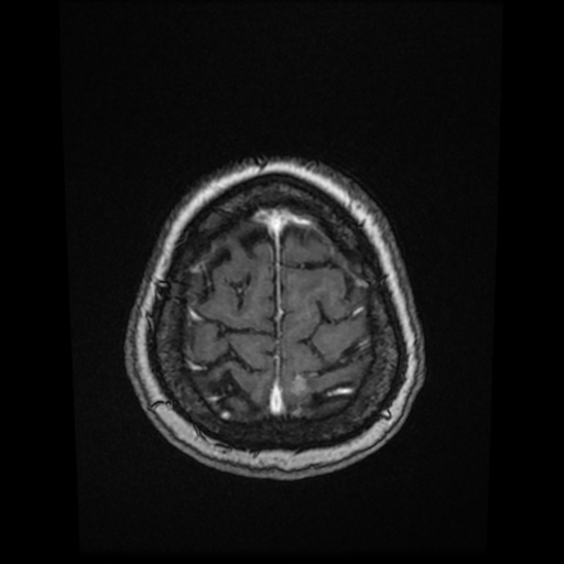 Cerebral metastases - melanoma (Radiopaedia 80972-94522 Axial T1 C+ 82).jpg