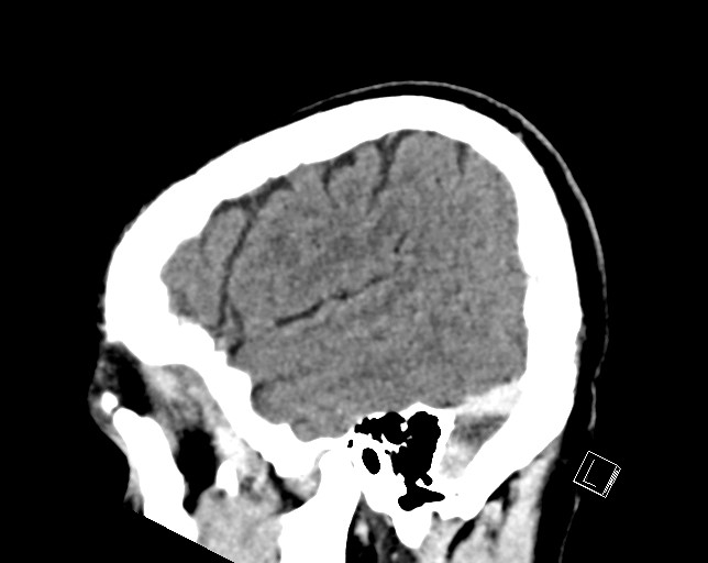 Cerebral metastases - testicular choriocarcinoma (Radiopaedia 84486-99855 F 47).jpg