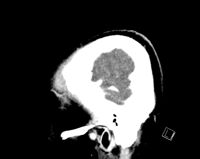 Cerebral metastases - testicular choriocarcinoma (Radiopaedia 84486-99855 F 9).jpg
