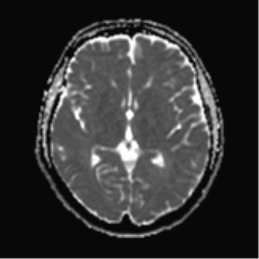 File:Cerebral metastases mimicking abscesses (Radiopaedia 45841-50131 Axial ADC 15).png