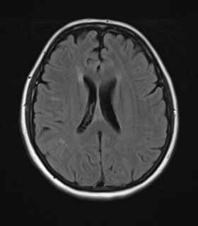 File:Cerebral metastases mimicking abscesses (Radiopaedia 45841-50131 Axial FLAIR 18).png