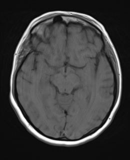 File:Cerebral metastases mimicking abscesses (Radiopaedia 45841-50131 Axial T1 13).png