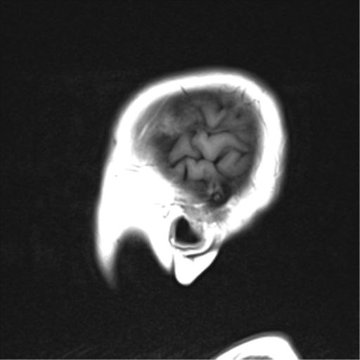 File:Cerebral metastases mimicking abscesses (Radiopaedia 45841-50131 G 1).png