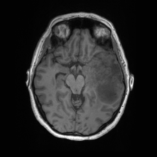 Cerebral metastasis mimicking glioblastoma (Radiopaedia 69155-78937 Axial T1 24).png