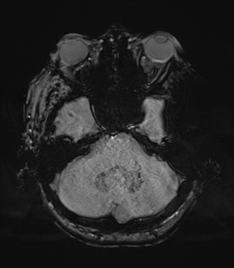 Cerebral metastasis to basal ganglia (Radiopaedia 81568-95413 Axial SWI 19).png
