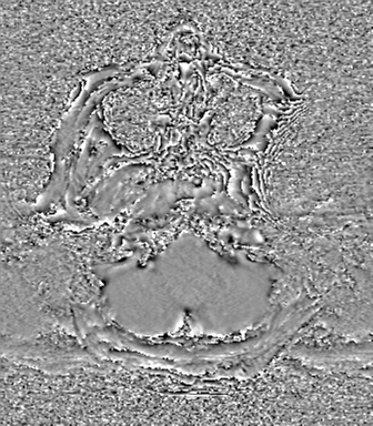 Cerebral metastasis to basal ganglia (Radiopaedia 81568-95413 Axial SWI phase 8).png