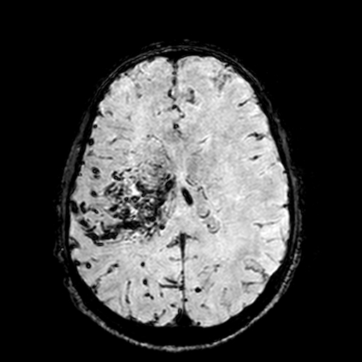Cerebral parenchymal arteriovenous malformation (Radiopaedia 27280-27456 Axial SWI 73).jpg