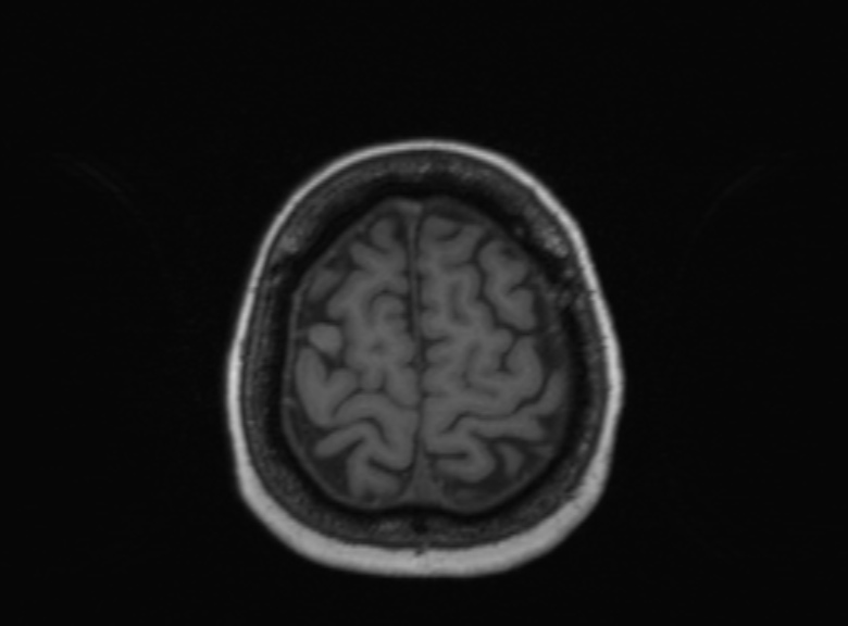 Cerebral ring enhancing lesions - cerebral metastases (Radiopaedia 44922-48817 Axial T1 127).jpg