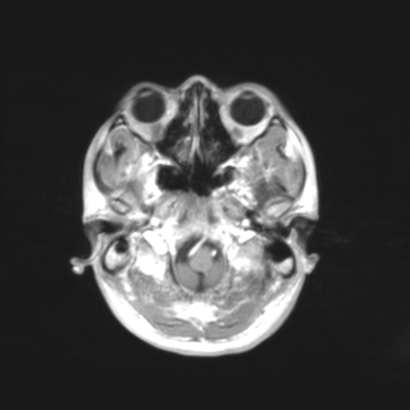 File:Cerebral toxoplasmosis (Radiopaedia 53993-61435 Axial T1 1).jpg