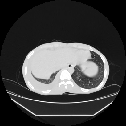 Cerebral tuberculoma (Radiopaedia 80829-94318 Axial lung window 158).jpg