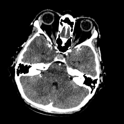 Cerebral tuberculosis with dural sinus invasion (Radiopaedia 60353-68019 Axial C+ delayed 17).jpg