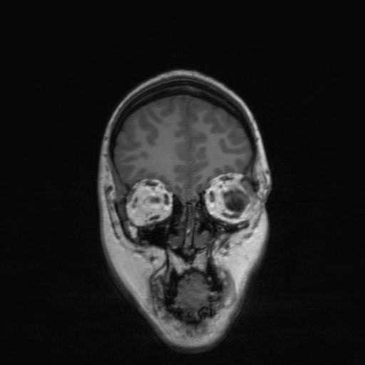 Cerebral tuberculosis with dural sinus invasion (Radiopaedia 60353-68090 Coronal T1 41).jpg