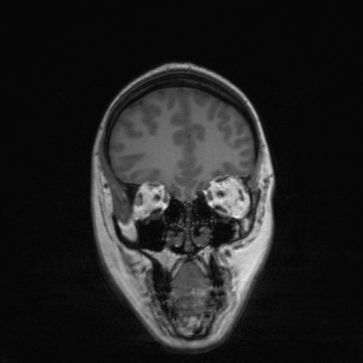 Cerebral tuberculosis with dural sinus invasion (Radiopaedia 60353-68090 Coronal T1 48).jpg