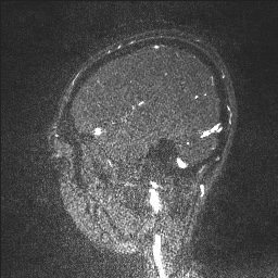 Cerebral tuberculosis with dural sinus invasion (Radiopaedia 60353-68090 Sagittal MRV 125).jpg