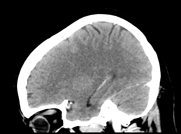 Cerebral venous hemorrhagic infarction (Radiopaedia 57576-64538 Sagittal C+ 37).png