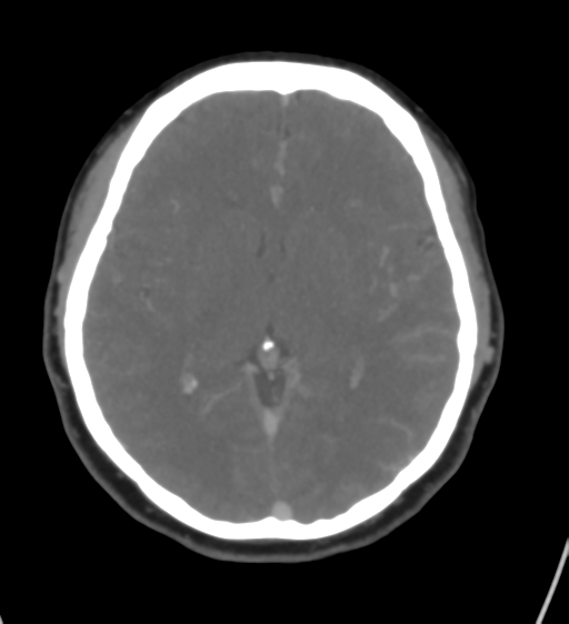 Cerebral venous infarction due to transverse sinus thrombosis (Radiopaedia 34688-36120 Axial CT venogram 26).png
